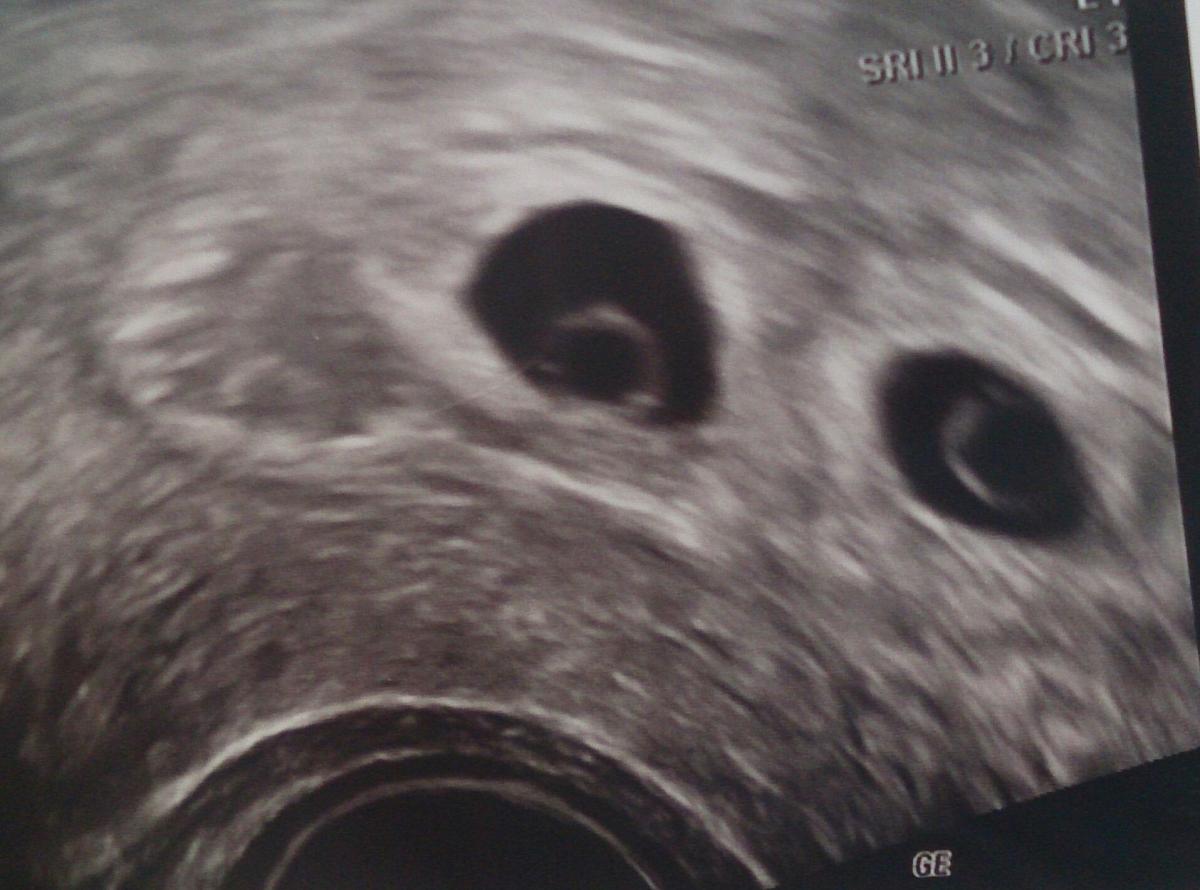 Gravid 3 uge